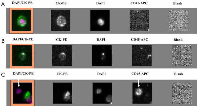 Circulating tumor cells detected in lung cancer patients using an indirect method, the CellSearch system. (A) Cell with a round morphology, a visible DAPI-positive nucleus, positive CK-PE staining in the cytoplasm and negative staining for CD45 is considered as typical intact CTC; (B) image of cell not included in the CTC count; (C) CD45-positive cell (arrows) is not considered as CTC. (Ilie, Marius, 2014)